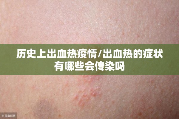 历史上出血热疫情/出血热的症状有哪些会传染吗