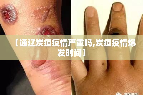 【通辽炭疽疫情严重吗,炭疽疫情爆发时间】 【通辽炭疽疫情严重吗,炭疽疫情爆发时间】